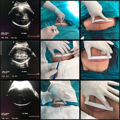 Can the Pfannenstiel skin incision length be adjusted according to the fetal head during elective cesarean delivery?